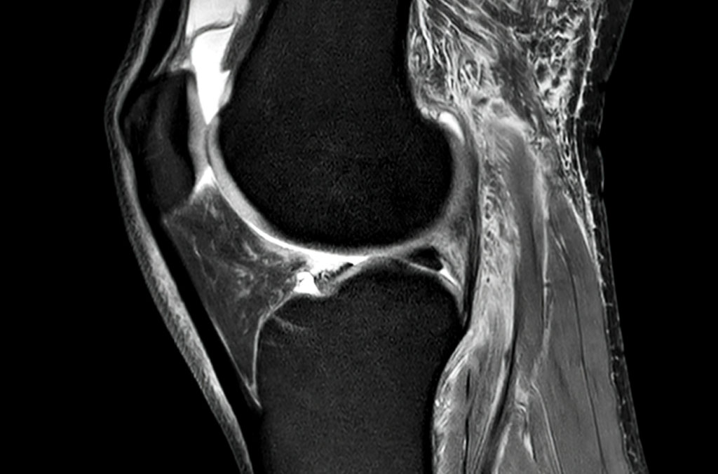 MRT-Bild von Knie
